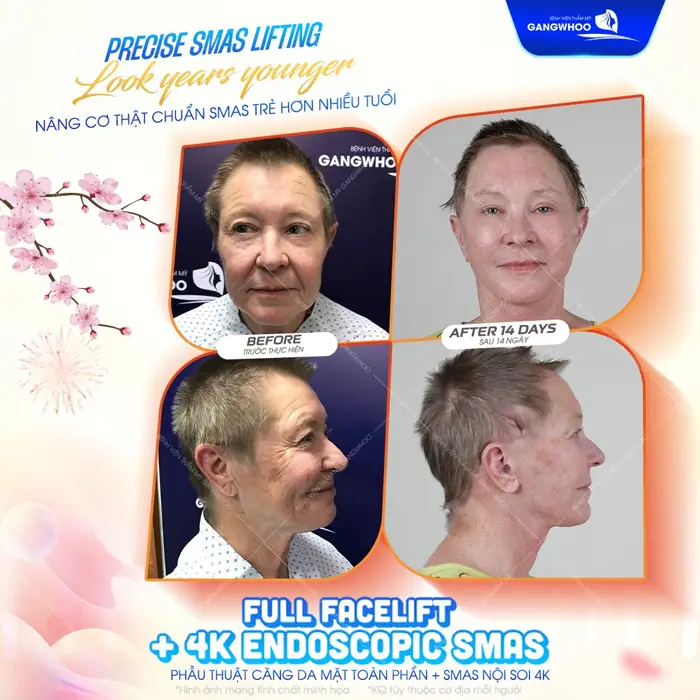 Hành Trình Níu Giữ Tuổi Xuân Của Đôi Bạn Thân 40 Năm Tại BVTM Gangwhoo 4 Nâng cơ chuẩn Smas trẻ hóa làn da đẹp chuẩn, an toàn và hiệu quả dài lâu
