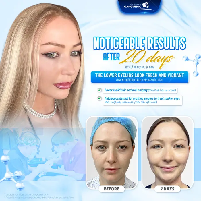 20 ngày kết quả cắt mí mắt dưới diện mạo tươi tẻ và tự tin hơn từng ngày