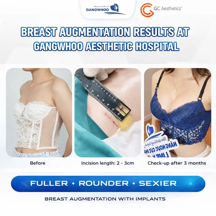 Breast augmentation results at Gangwhoo are highly rated