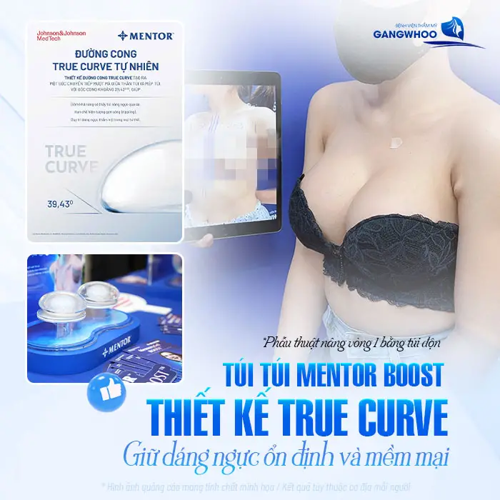 Nâng Ngực Túi Mentor Boost: Vòng 1 Chuẩn Đẹp, Mềm Mại & Tự Nhiên Dài Lâu