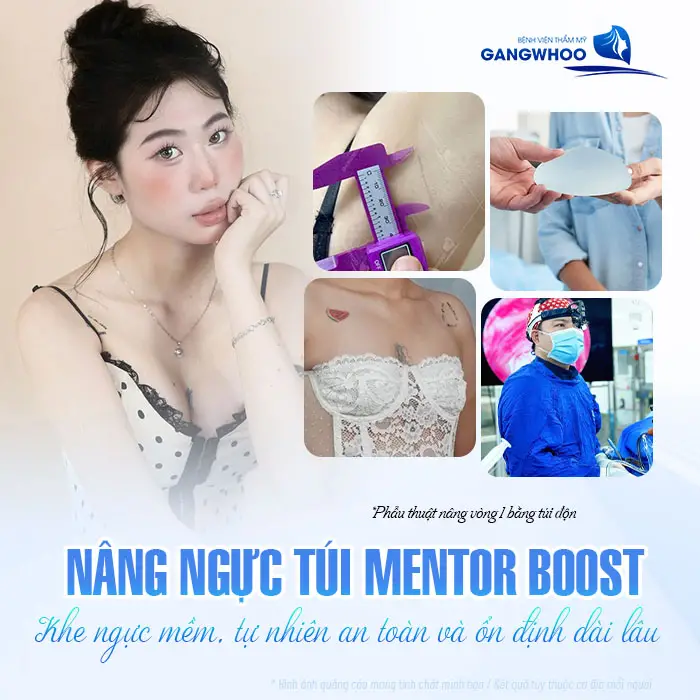 Nâng Ngực Túi Mentor Boost: Vòng 1 Chuẩn Đẹp, Mềm Mại & Tự Nhiên Dài Lâu
