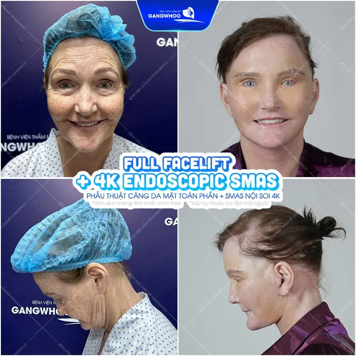 Kết quả sau phẫu thuạt căng da mặt toàn phần ứng dụng công nghệ nội soi 4K hiện đại 