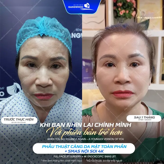 Top 8 Bác Sĩ Căng Da Mặt Nổi Tiếng Với Tay Nghề Cao