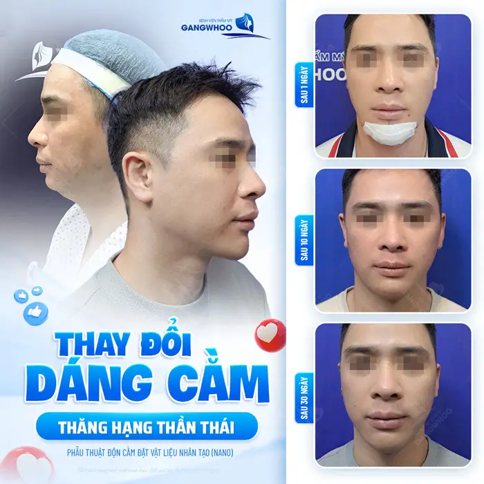 Top 11 Bác Sĩ Độn Cằm Giỏi Nhiều Người Tin Chọn Tại TPHCM