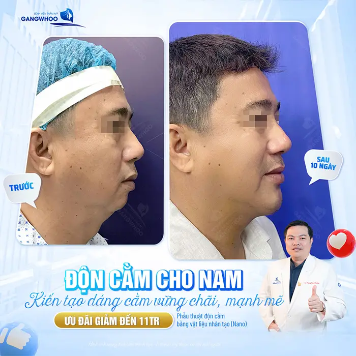 Độn cằm cho nam kiến tạo dáng cằm đẹp vững chãi, mạnh mẽ với đường nét thanh thoát và hài hòa