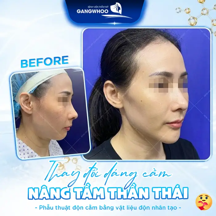 Top 11 Bác Sĩ Độn Cằm Giỏi Nhiều Người Tin Chọn Tại TPHCM