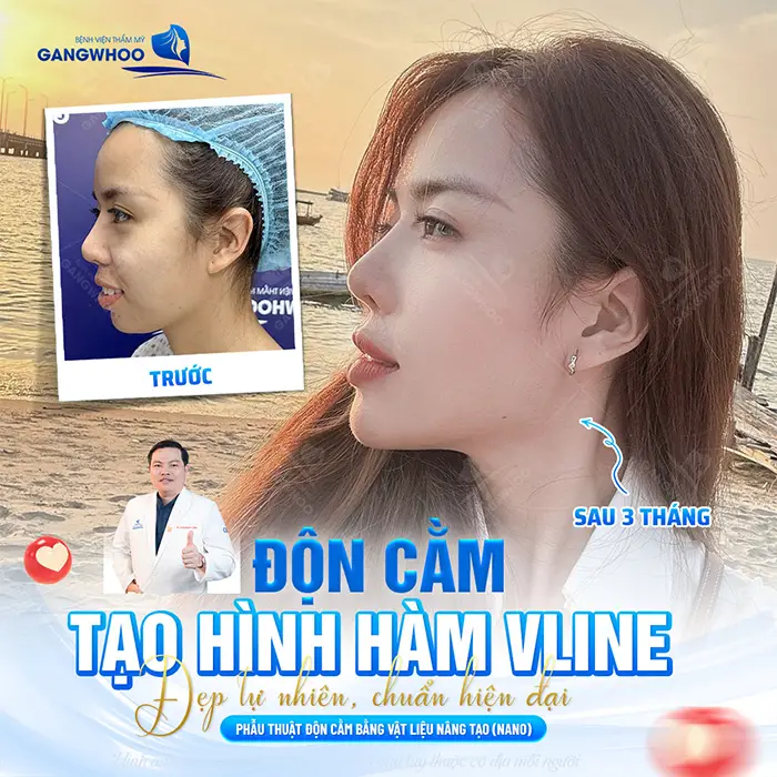 7 ngày sau độn cằm, tự tin với dáng cằm đẹp thon gọn chuẩn Vline thăng hạng diện mạo thêm hoàn hảo