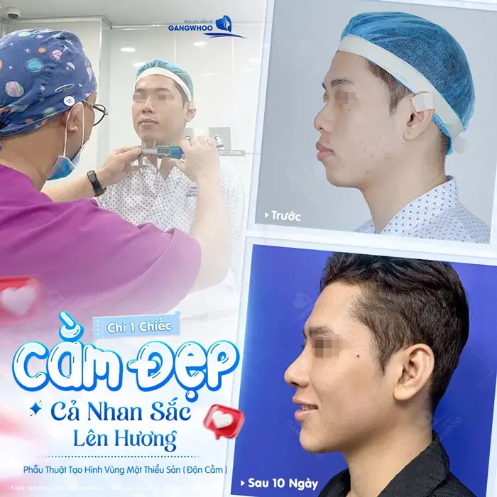 Top 9 Địa Chỉ Độn Cằm Tại TPHCM Được Chuyên Gia Đánh Giá Cao 1 Chỉ 1 chiếc cằm cả nhan sắc lên hương đẹp chuẩn hài hòa và thăng hạng hơn thấy rõ