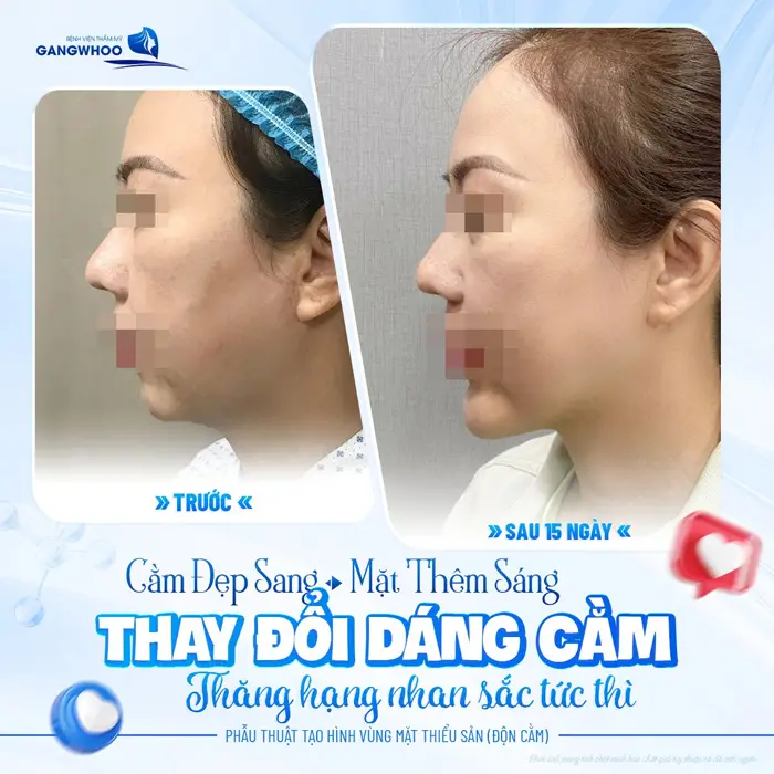 Cằm đẹp sang mặt thêm sáng thay đổi sáng cằm thăng hạng nhan sắc đẹp ngay tức thì