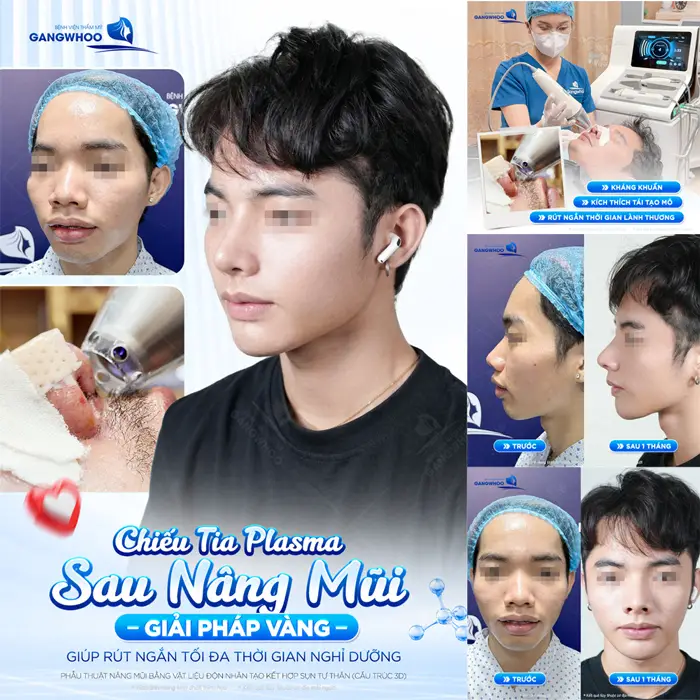 Chiếu tia Plasma sau nâng mũi giải pháp vàng giúp rút ngắn tối đa thời gian nghỉ dưỡng