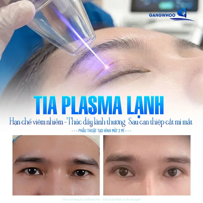 Chiếu Tia Plasma Lạnh – Giải Pháp Hỗ Trợ Phục Hồi Sau Thẩm Mỹ
