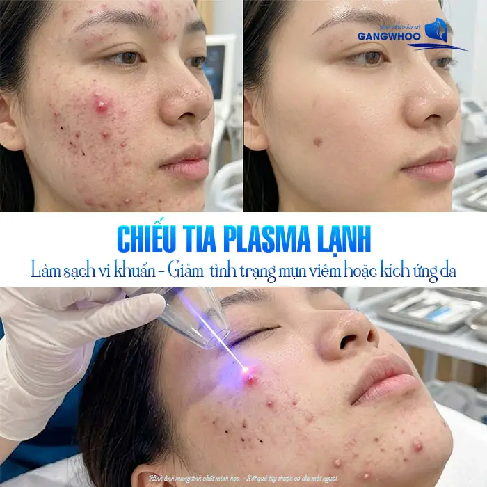 Chiếu Tia Plasma Lạnh – Giải Pháp Hỗ Trợ Phục Hồi Sau Thẩm Mỹ