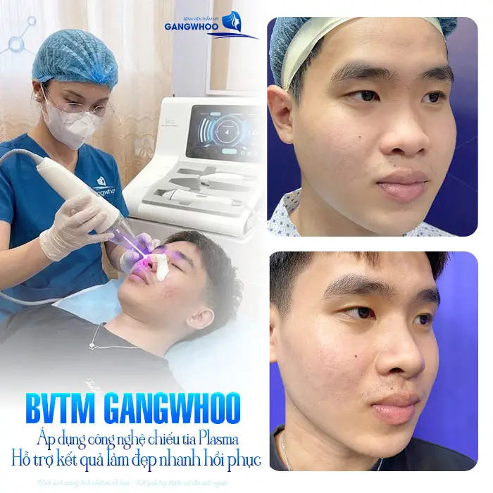 Chiếu Tia Plasma Lạnh – Giải Pháp Hỗ Trợ Phục Hồi Sau Thẩm Mỹ