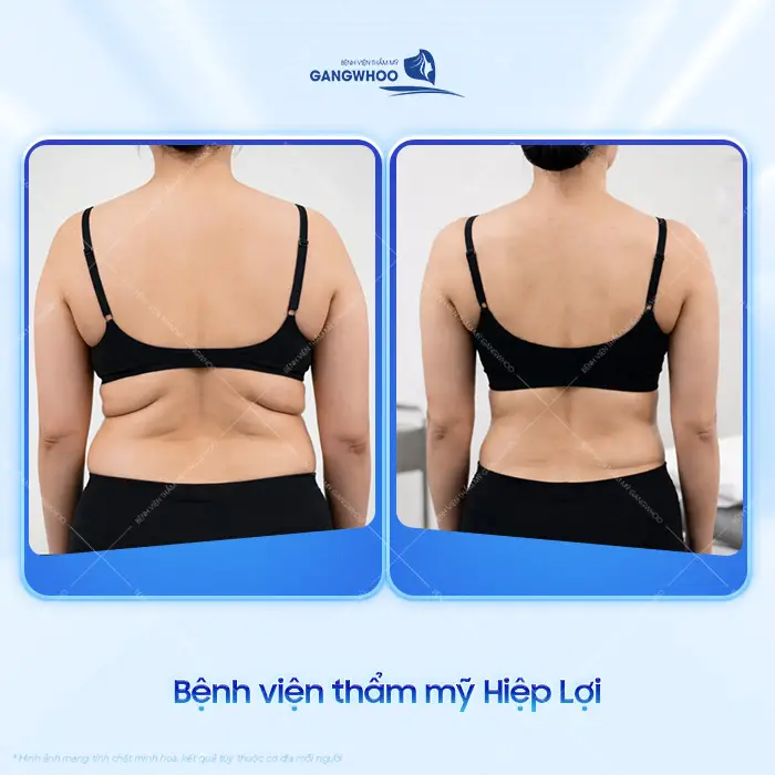 Top 10 Địa Chỉ Hút Mỡ Lưng Tại TPHCM Được Khách Hàng Lựa Chọn