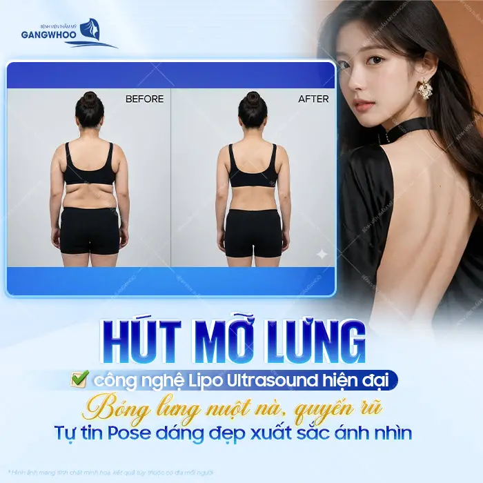 Top 10 Địa Chỉ Hút Mỡ Lưng Tại TPHCM Được Khách Hàng Lựa Chọn