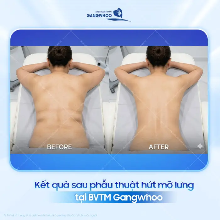 Top 10 Địa Chỉ Hút Mỡ Lưng Tại TPHCM Được Khách Hàng Lựa Chọn