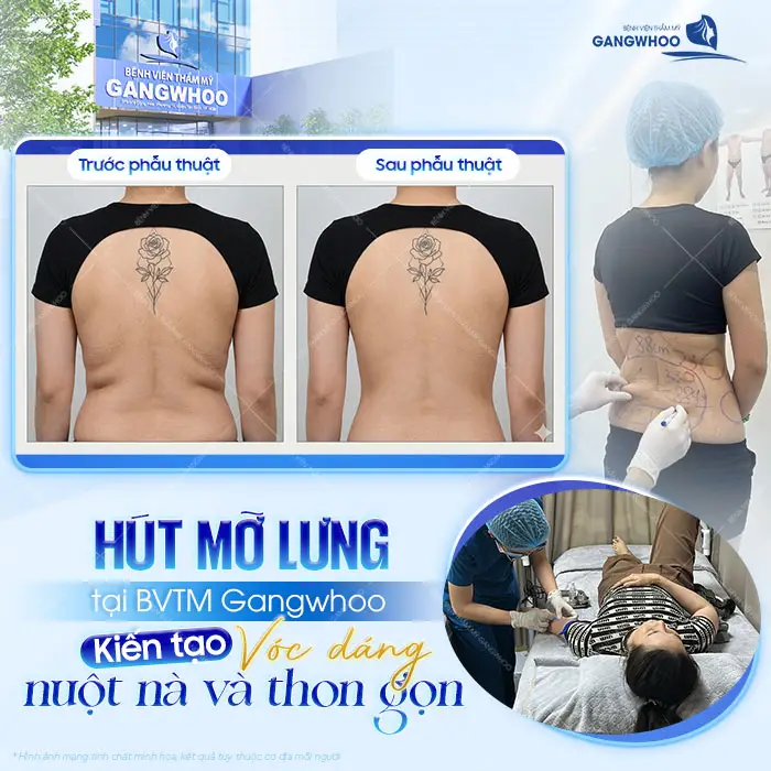 Top 10 Địa Chỉ Hút Mỡ Lưng Tại TPHCM Được Khách Hàng Lựa Chọn