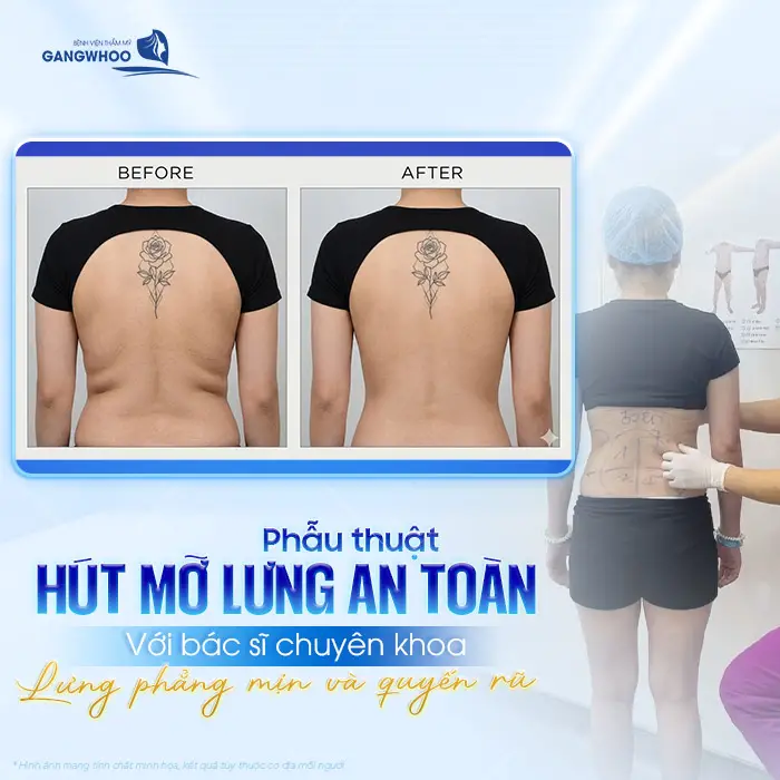 Top 10 Địa Chỉ Hút Mỡ Lưng Tại TPHCM Được Khách Hàng Lựa Chọn