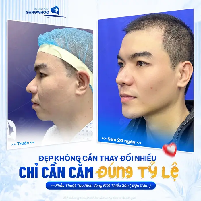 Độn Cằm Bao Lâu Thì Tháo Băng? Những Yếu Tố Ảnh Hưởng 1 Đẹp không cần thay đổi nhiều chỉ cần căn chỉnh phần cằm đúng tỷ lệ gương mặt đã thay đổi đẹp xuất sắc