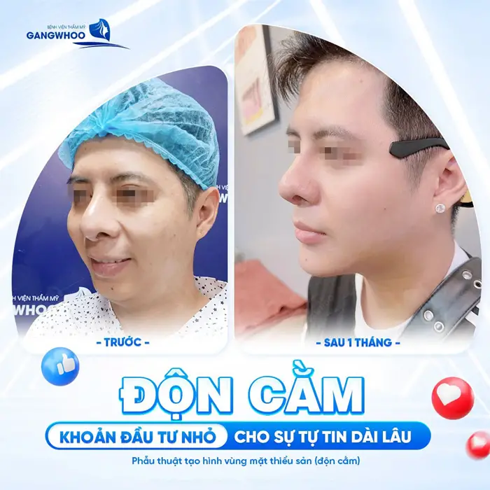 Độn cằm là khoản đầu tư cho sự tự tin dài lâu kết quả sau 1 tháng diện mạo đã ấn tượng và thăng hạng hơn thấy rõ