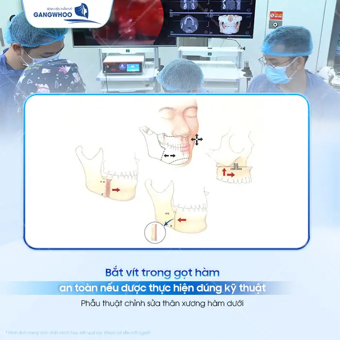 Gọt Hàm Có Bắt Vít Không? Vì Sao Phải Nẹp Vít?