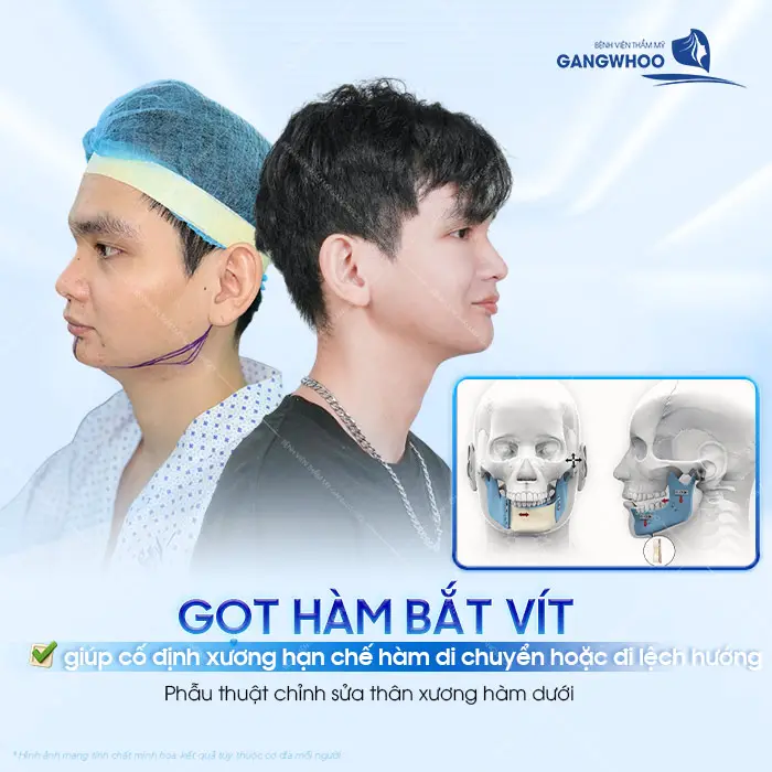Gọt Hàm Có Bắt Vít Không? Vì Sao Phải Nẹp Vít?