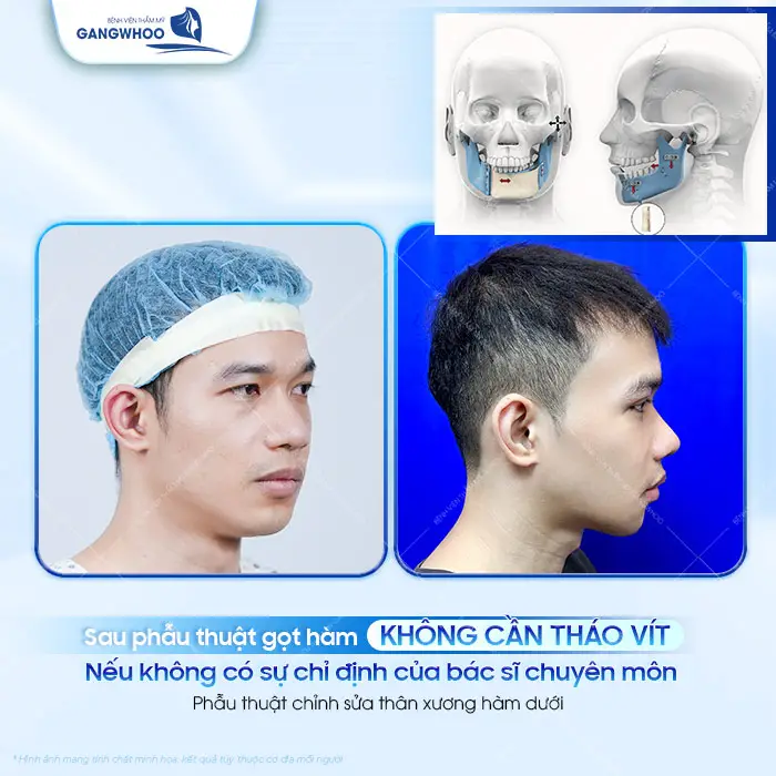 Gọt Hàm Có Bắt Vít Không? Vì Sao Phải Nẹp Vít?