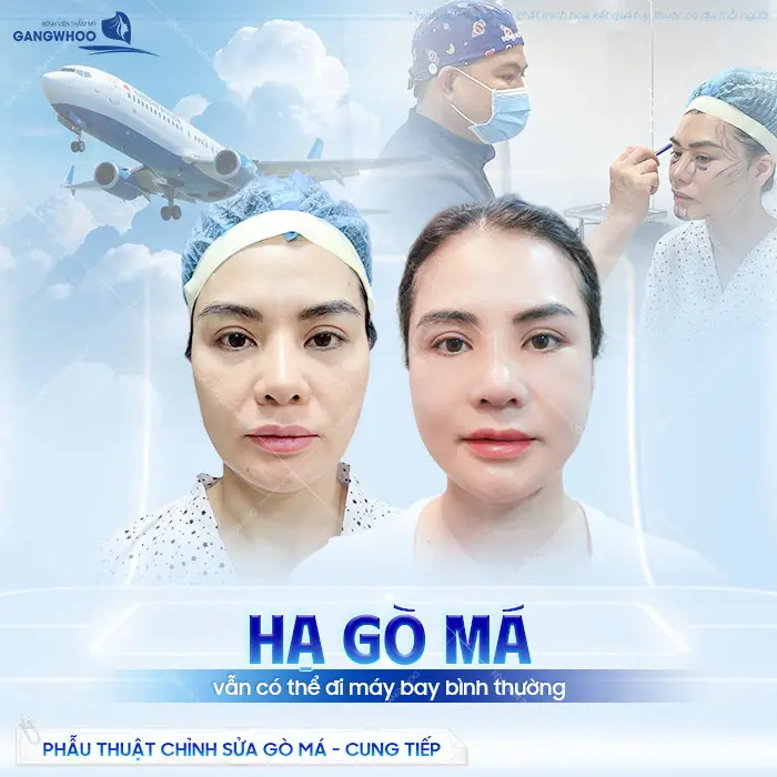 Hạ Gò Má Gắn Ốc Vít Có Đi Máy Bay Được Không? Bác Sĩ Giải Đáp