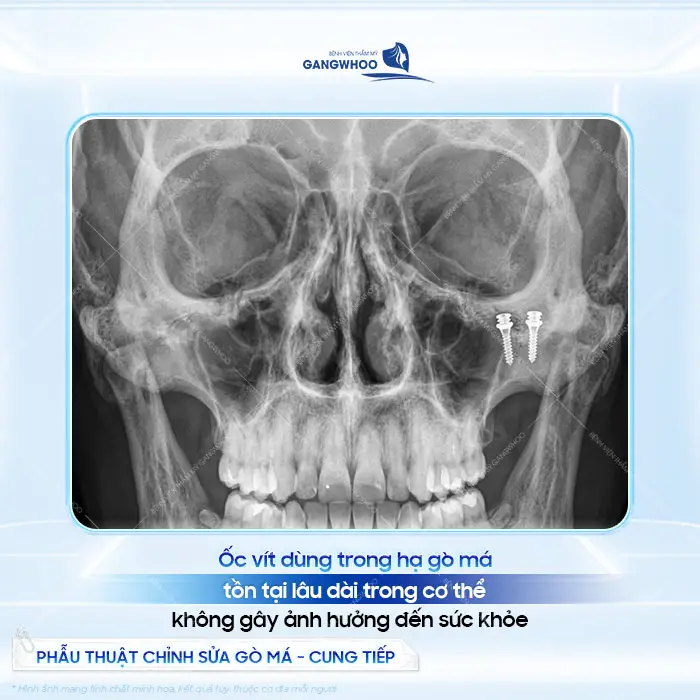 Ốc vít dùng trong hạ gò má tồn tại lâu dài trong cơ thể mà không gây ảnh hưởng đến sức khỏe