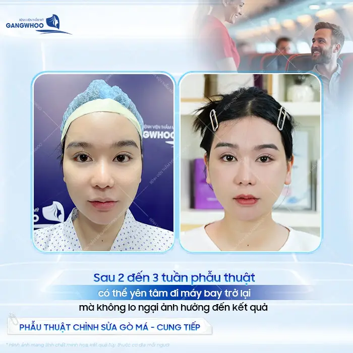 Sau 2 đến 3 tuần phẫu thuật có thể yên tâm đi máy bay trở lại mà không lo ngại ảnh hưởng đến kết quả