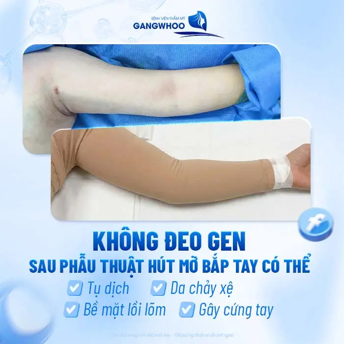 Hút Mỡ Bắp Tay Đeo Gen Bao Lâu? Hướng Dẫn Đeo Gen Đúng Chuẩn