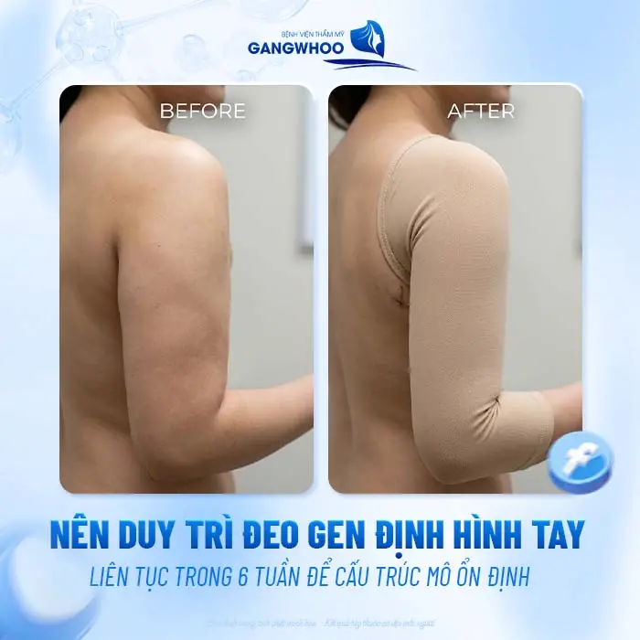 Hút Mỡ Bắp Tay Đeo Gen Bao Lâu? Hướng Dẫn Đeo Gen Đúng Chuẩn