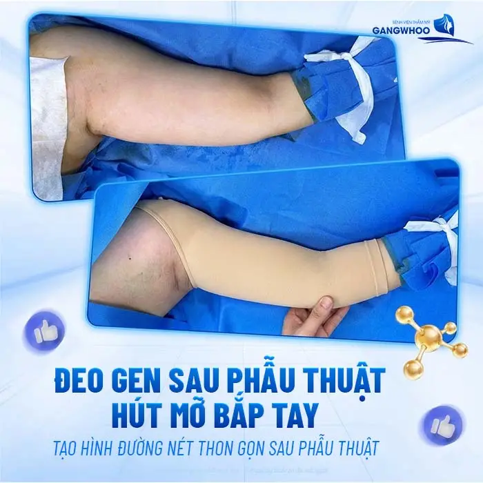 Hút Mỡ Bắp Tay Đeo Gen Bao Lâu? Hướng Dẫn Đeo Gen Đúng Chuẩn
