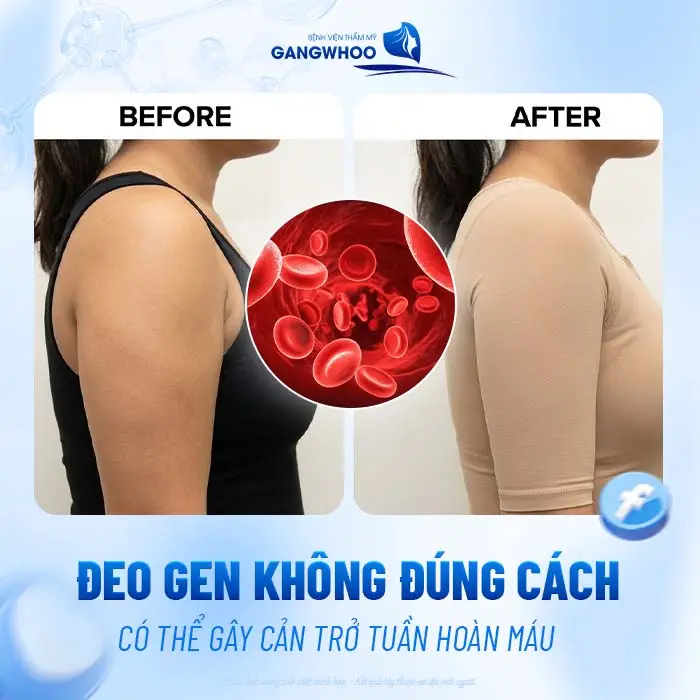 Hút Mỡ Bắp Tay Đeo Gen Bao Lâu? Hướng Dẫn Đeo Gen Đúng Chuẩn