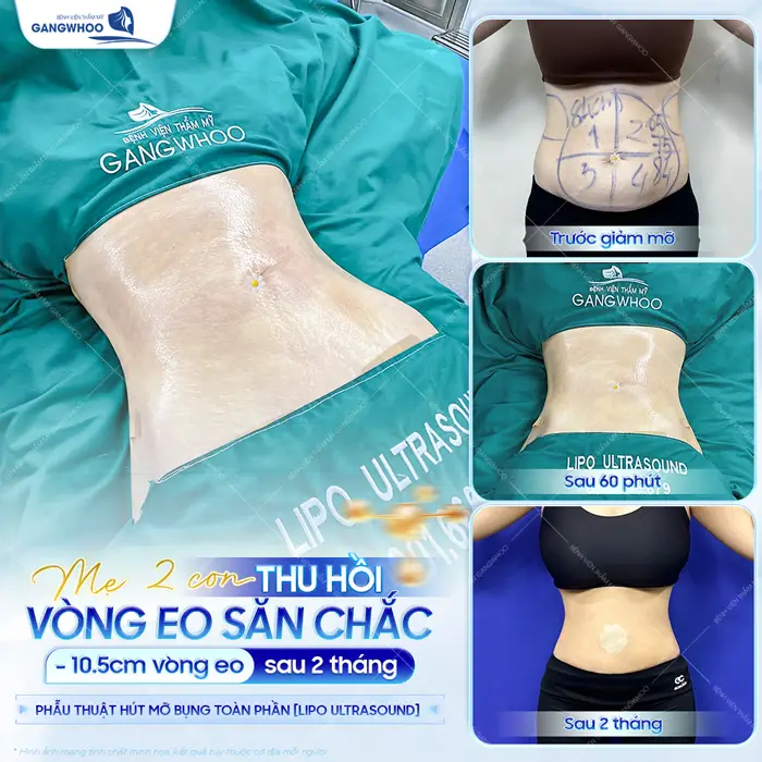 60 phút thay đổi gánh nặng sau nhiều năm giảm mỡ bụng công nghệ Lipo Ultrasound an toàn - nhẹ nhàng và hiệu quả nhanh