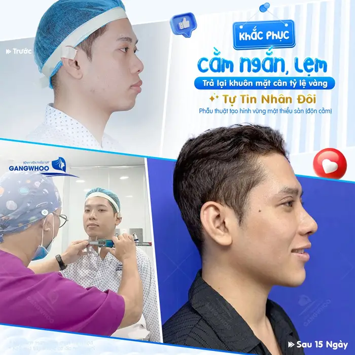 Top 9 Địa Chỉ Độn Cằm Tại TPHCM Được Chuyên Gia Đánh Giá Cao 5 Khắc phục cằm lẹm, ngắn trả lại khuôn mặt cân đối tỷ lệ vàng sự tự tin nhân đôi
