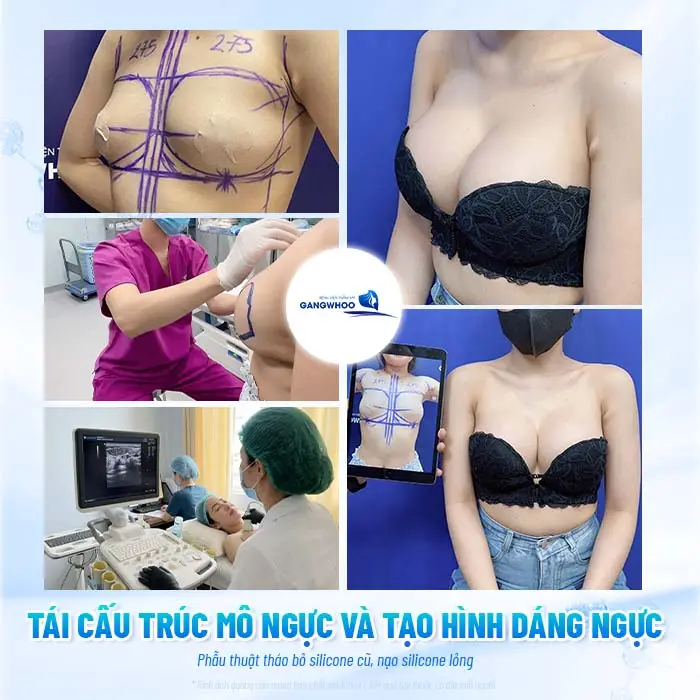 Sửa Ngực Hỏng Tiêm Filler: Cách Xử Lý An Toàn Và Hiệu Quả