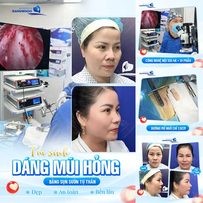 Top 10 Loại Sụn Nâng Mũi Phổ Biến Bác Sĩ Khuyên Dùng