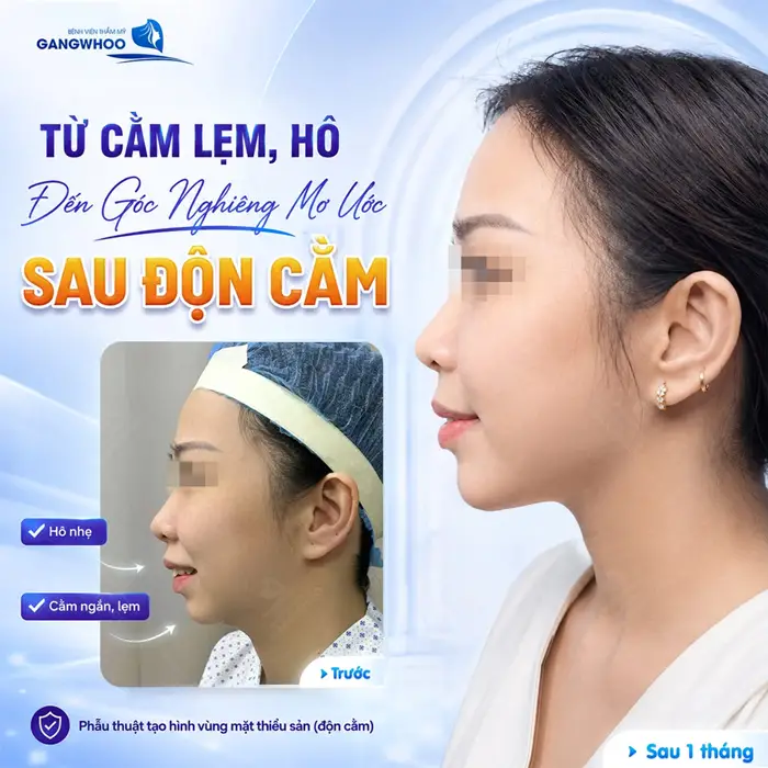 Từ cằm lẹm, hô đến góc nghiêng mơ ước sau độn cằm kết quả sau 1 tháng đẹp xuất sắc