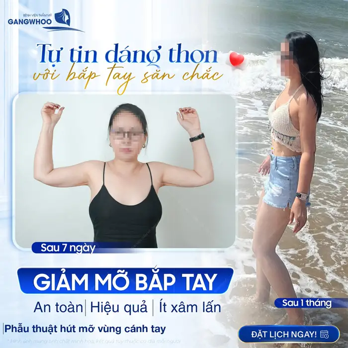 Tự tin dáng thon sau phẫu thuật an toàn hơn, hiệu quả hơn và không lo xâm lấn