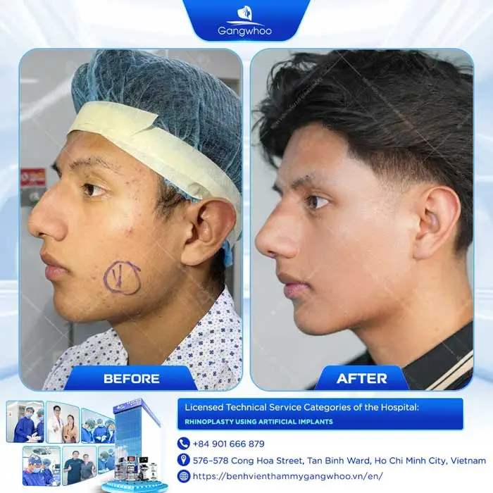 Rhinoplasty