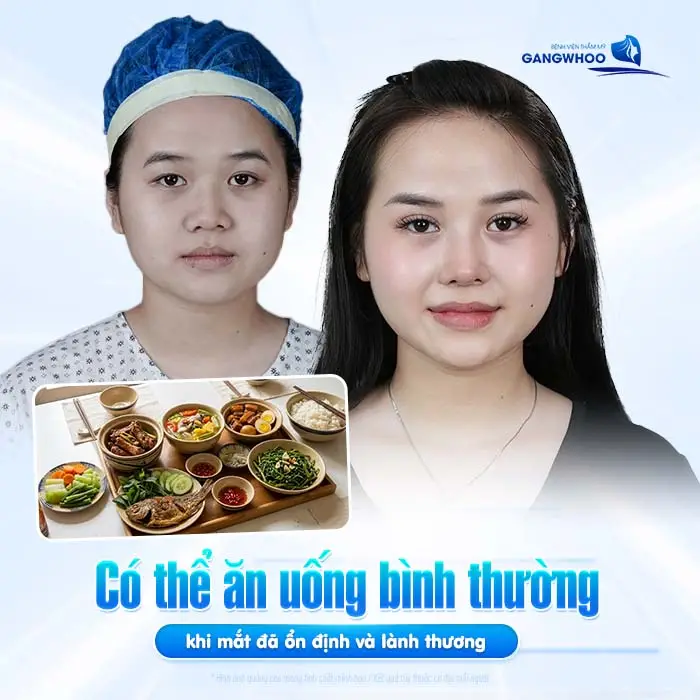 Cắt Mí Mắt Ăn Thịt Vịt Được Không? Bác Sĩ Giải Đáp