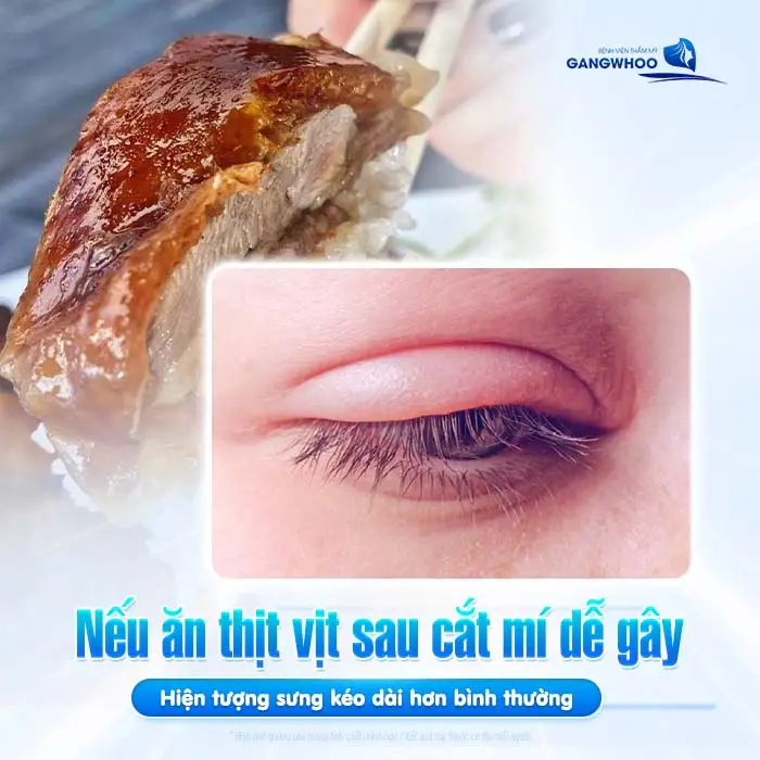 Cắt Mí Mắt Ăn Thịt Vịt Được Không? Bác Sĩ Giải Đáp