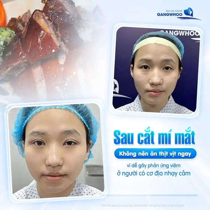 Cắt Mí Mắt Ăn Thịt Vịt Được Không? Bác Sĩ Giải Đáp