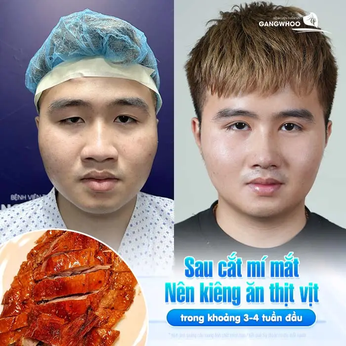 Cắt Mí Mắt Ăn Thịt Vịt Được Không? Bác Sĩ Giải Đáp