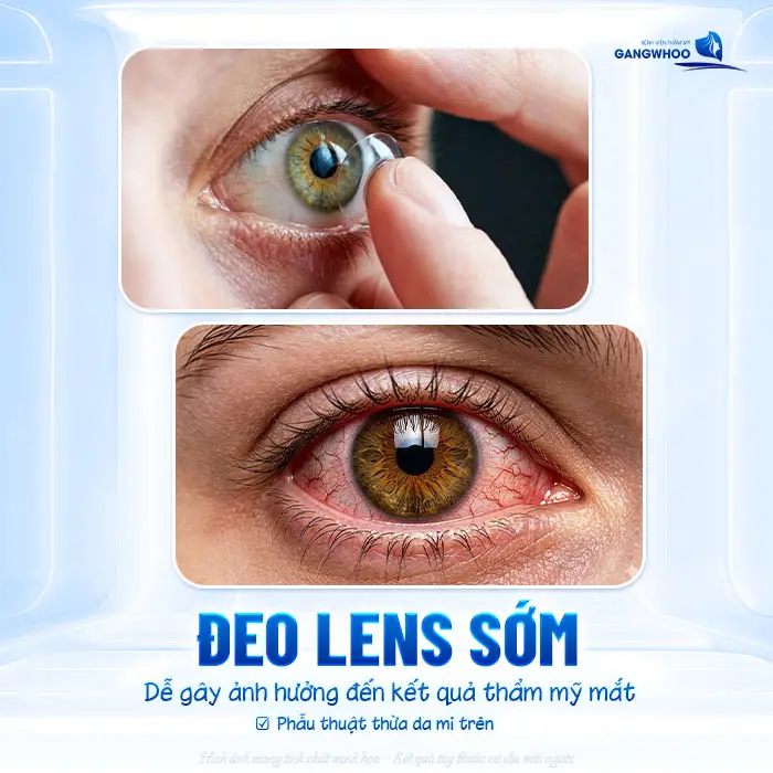 Sau Cắt Mí Mắt Bao Lâu Được Đeo Kính Áp Tròng? Bác Sĩ Giải Đáp