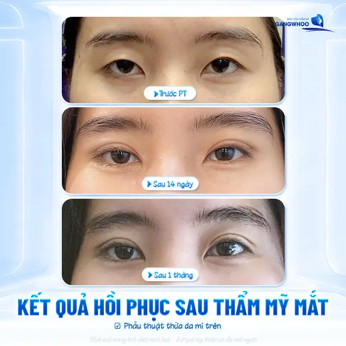 Sau Cắt Mí Mắt Bao Lâu Được Đeo Kính Áp Tròng? Bác Sĩ Giải Đáp
