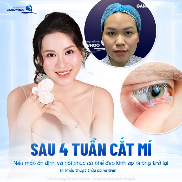 Sau Cắt Mí Mắt Bao Lâu Được Đeo Kính Áp Tròng? Bác Sĩ Giải Đáp