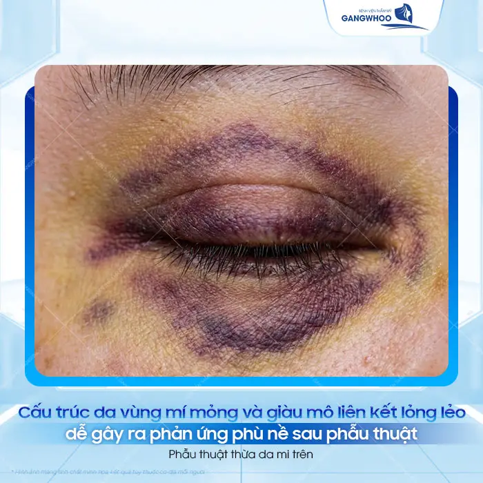 Cắt Mí Mắt Bị Sưng Bầm Bao Lâu Hết? Cách Giảm Sưng Nhanh