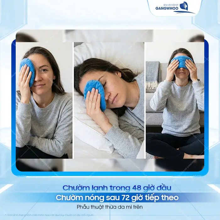 Cắt Mí Mắt Bị Sưng Bầm Bao Lâu Hết? Cách Giảm Sưng Nhanh